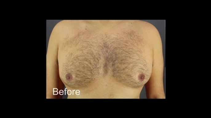 BodyTite for Gynecomastia