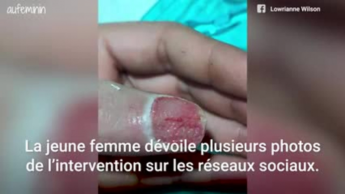 Elle perd son pouce après faux ongles