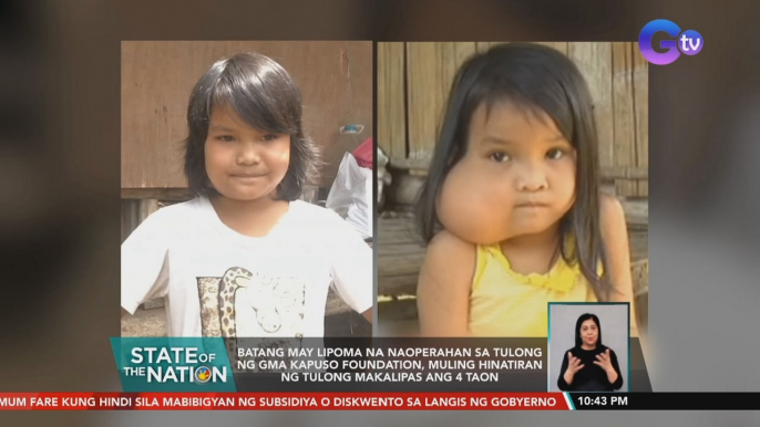 Batang may lipoma na naoperahan sa tulong ng GMA Kapuso Foundation, muling hinatiran ng tulong makalipas ang 4 taon | SONA