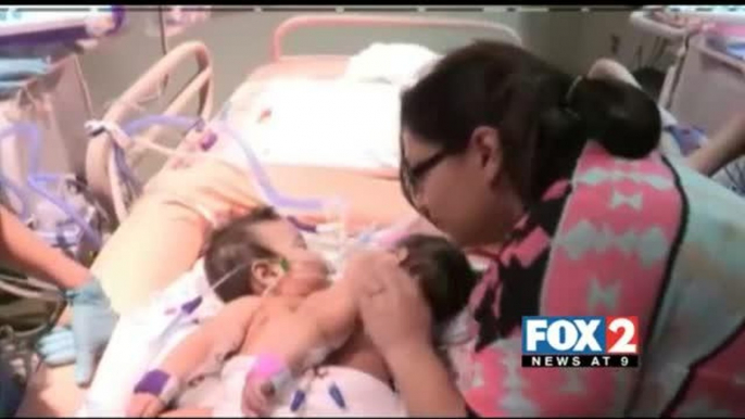 Texas Conjoined Twins Undergoing Separation Surgery