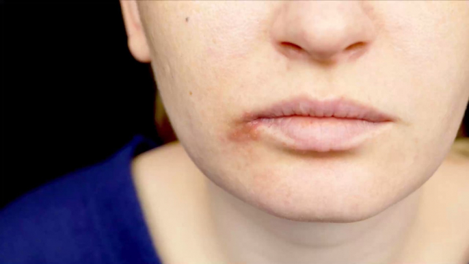 Home remedies to get rid of cold sores