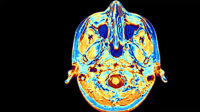 Coronavirus : le Covid-19 a-t-il des effets sur notre cerveau ?