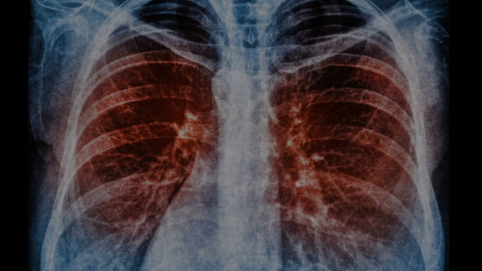 New Type of Cell Discovered in Human Lungs May Lead to Novel Treatments