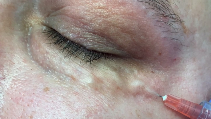 Carboxytherapy helps treat dark under-eyes
