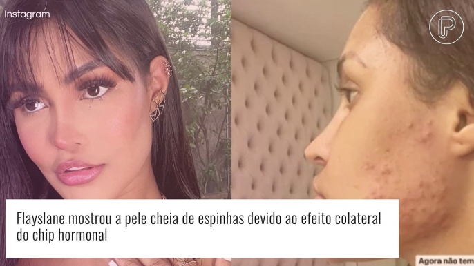 Flay explica espinhas por causa do chip da beleza: 'Destruiu minha pele'. Saiba detalhes!