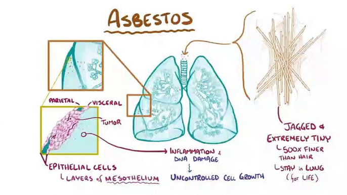 Mesothelioma  Causes, symptoms, diagnosis, treatment, pathology