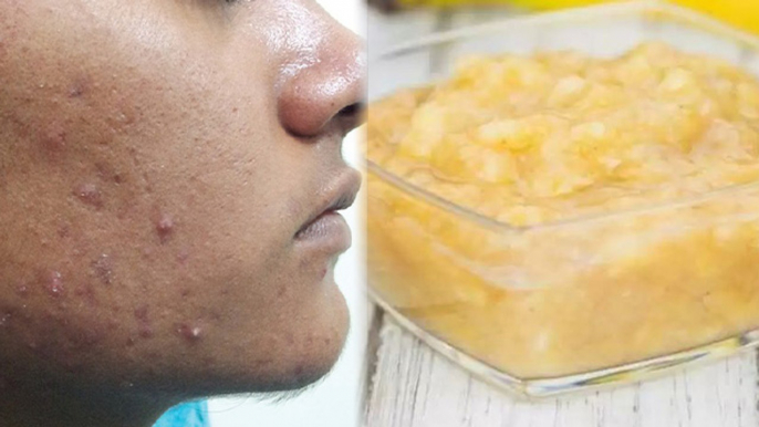 Pimple इस 1 चीज को लगाने से होगा गायब, Banana For Pimples । Boldsky *Health