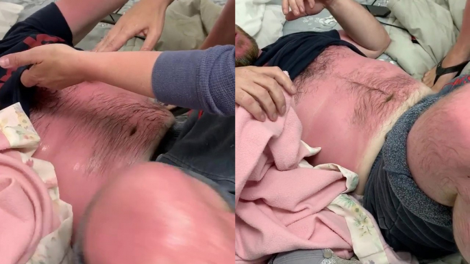 Man in severe pain after getting a BAD sunburn, can't even take his shirt off