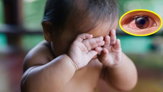 Conjunctivitis In Babies: Baby Pink या Red Eye Home Remedy | बच्चे की आंख लाल होने पर क्या करें