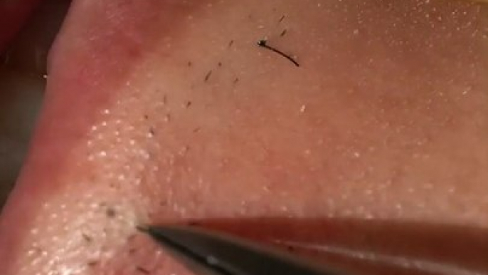 Super Satisfying Ingrown Hair Removal Ingrown Hair Removal 2022 Compilation3 #shorts