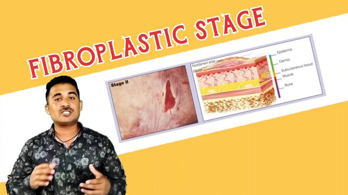 Fibroplastic Stage