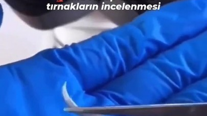 Tırnak yeme alışkanlığı olanlara uyarı