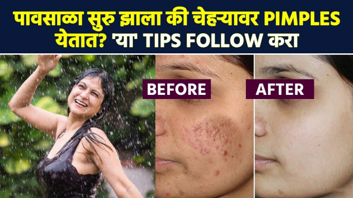 पावसामुळे चेहऱ्यावर Pimples येतात? लगेचच 'हे' उपाय करा | How to Get Rid of Pimples Lokmat Sakhi MA3