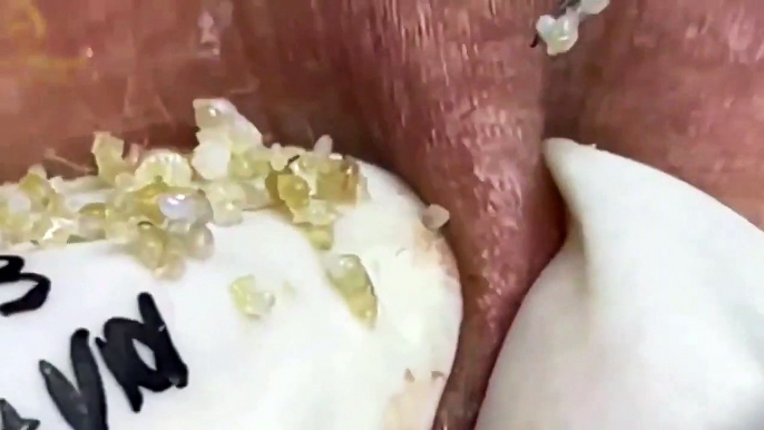 Cyst- Blackheads- Pimples- Acne- Steatocystoma 6