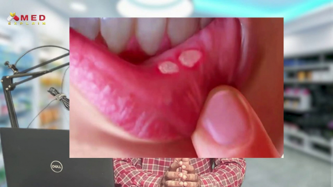 Mouth ulcer Orasep gel मुँह के छाले Use of Orasep Gel मुँह आना Side effects of Orasep gel | ORASEP GEL USES , BENEFITS , SIDE EFFECTS | Mouth ulcer | Mouth ulcer treatment | मुँह के छाले | मुँह के छालों का इलाज  | औरासेप जेल , | औरासेप जेल के फायदे  |