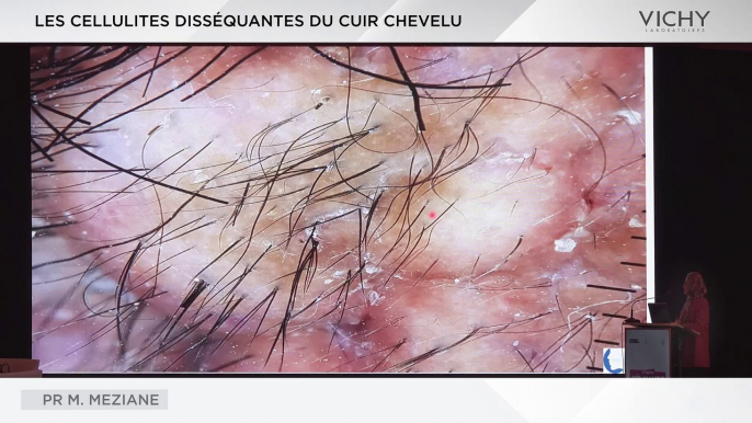 Les cellules disséquantes du cuir chevelu par Pr M. MEZIANE