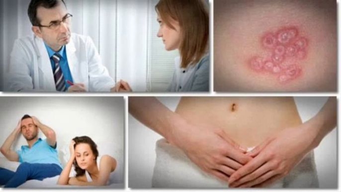 Get Rid of Herpes Forever WOW Get Rid of Herpes