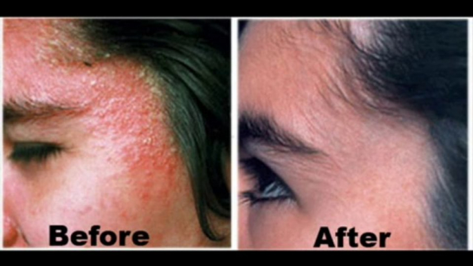 Eczema Free Forever ==GET DISCOUNT NOW==