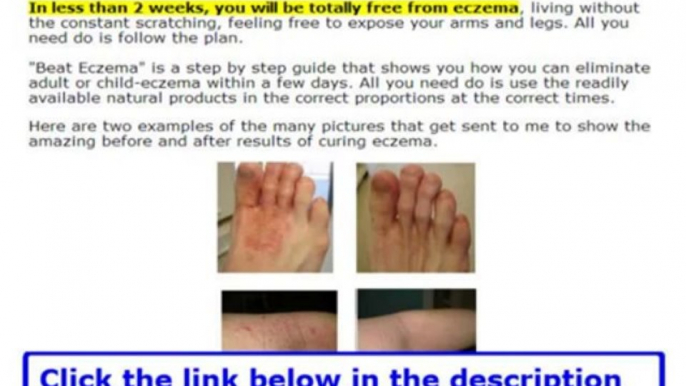 Beat Eczema Now Reviews + Beat Eczema Pdf