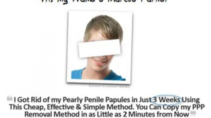 Natural and effective pearly penile papules removal