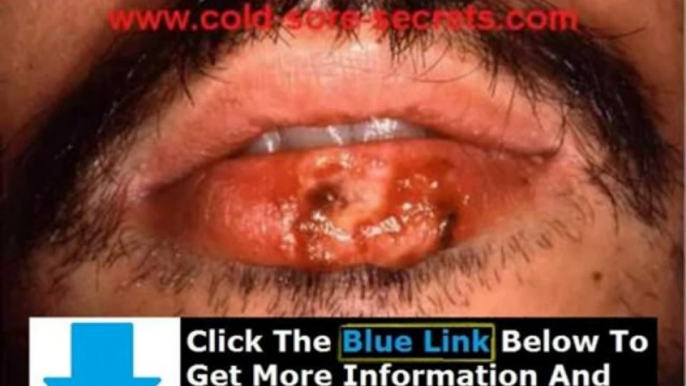 How To Get Rid Of Herpes For Good + Get Rid Of Herpes Blisters Fast