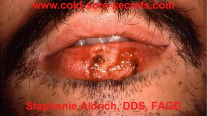 Herpes Answers- How To Get Rid of Cold Sores Fast!