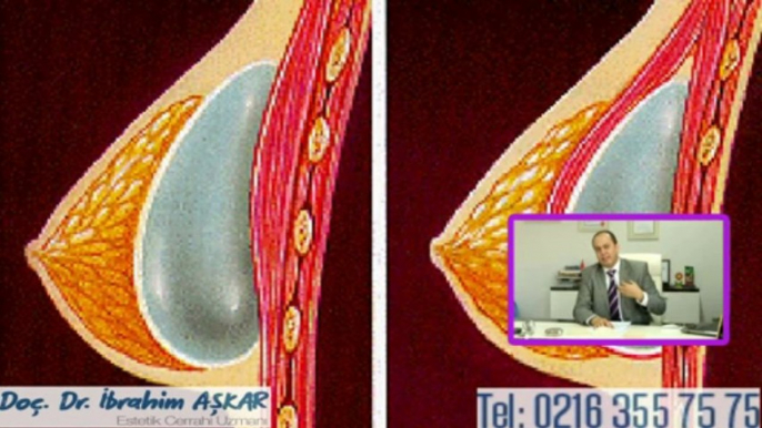 Doç. Dr. İbrahim Aşkar Meme Estetigi 2. Bolum