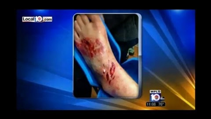 Shark attack in Florida: shark mauls teen's leg