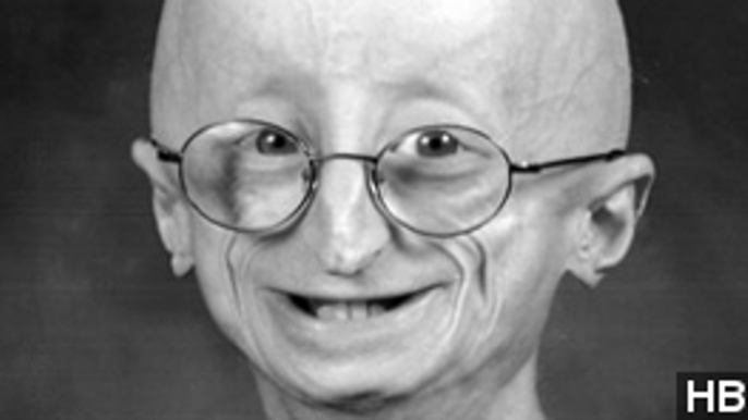 Sam Berns, Teen With Rapid Aging Disease, Dies At 17