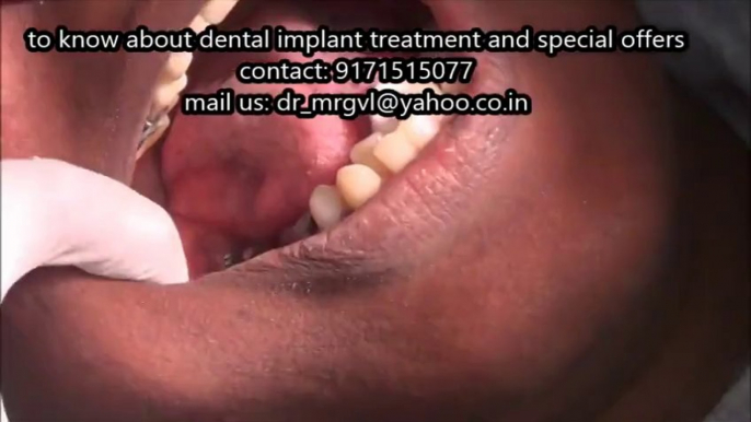 Tooth and Implant supported PFM bridge in lower molar region-fixing video