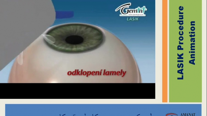 PRK-Lasik-Femto Procedures