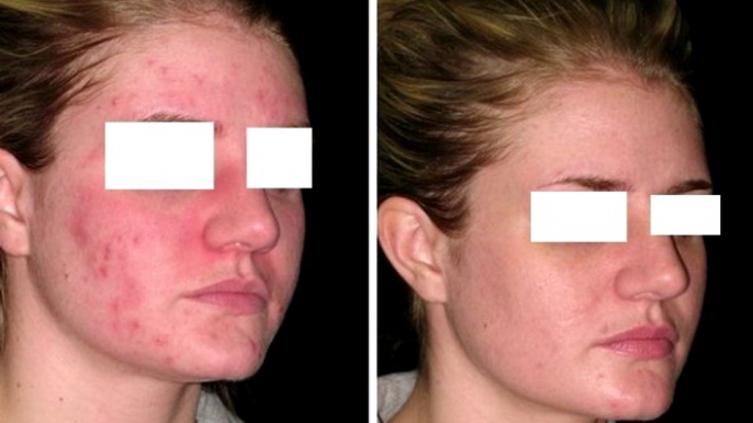 Acné L'ACNÉ Pimples Remove Acne Remove Pimples 2014