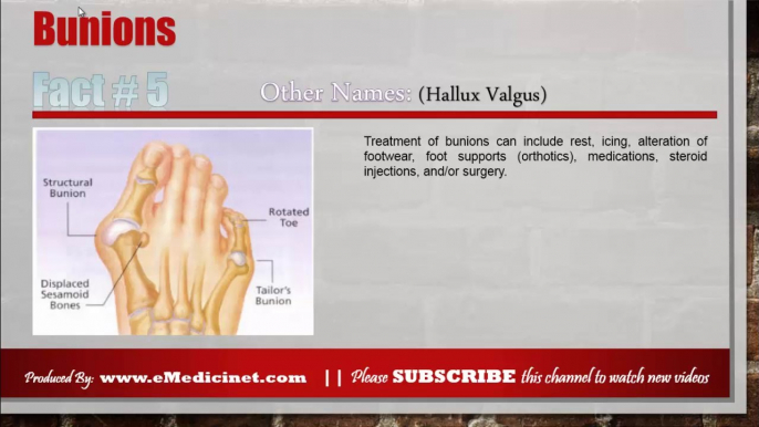 Information about Bunions (Hallux Valgus)