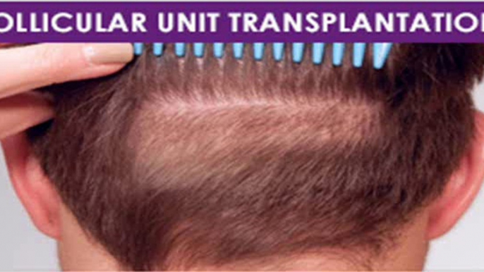Hair Transplant in Dubai | Hair Transplantation in Dubai