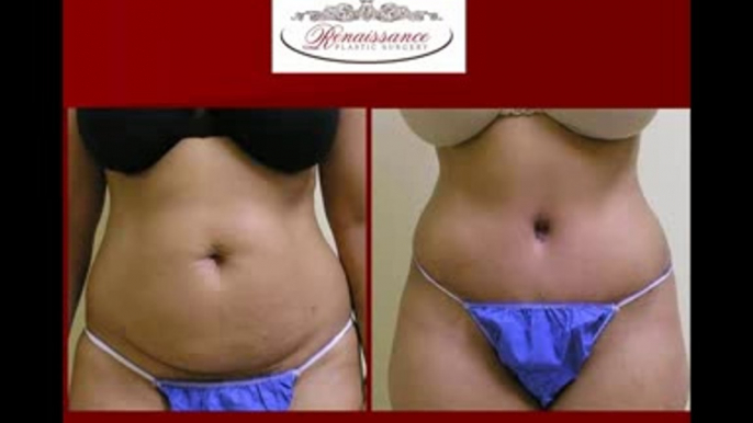 Abdominoplasty or Tummy Tuck at Renaissance Plastic Surgery