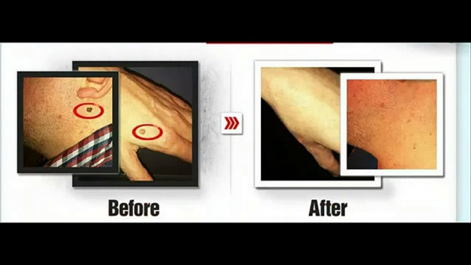 Moles Warts _ Skin Tags Removal - Removing Skin Tags At Home Guide - Review