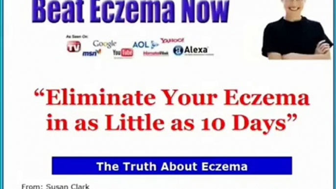 Beat Eczema Now Review