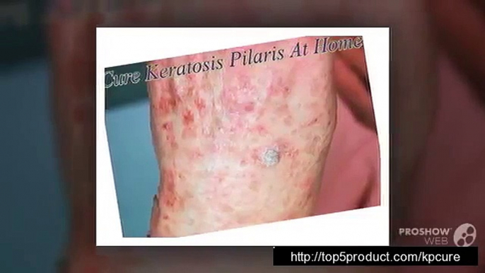 Keratosis Pilaris Cure Diet  Keratosis Pilaris Cures Natural - Living With Kp Review