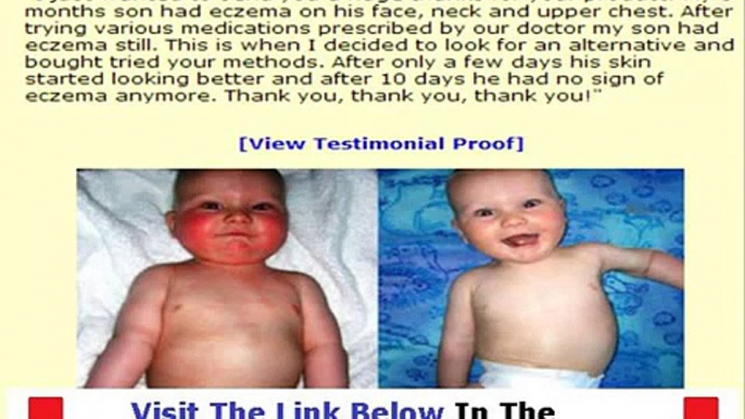 Eczema Free Forever THE HONEST TRUTH Bonus + Discount