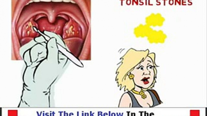 Banish Tonsil Stones FACTS REVEALED Bonus + Discount