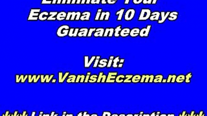 Beat Eczema With Proper Eczema Natural Remedy