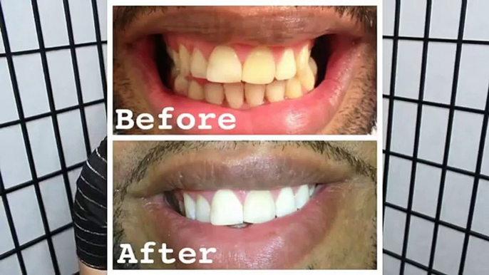 Homemade Teeth Whitening