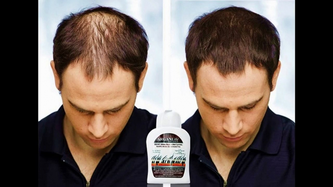 How to Regrow Thinning or Balding Hair & ARGANLife Products