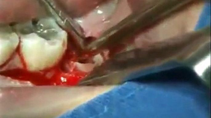 extraction wisdom tooth impacted (www.oralcamera.net)