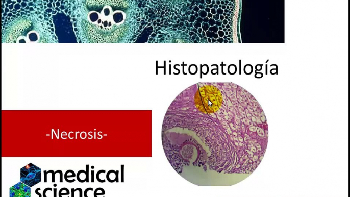 Histopatología - Necrosis II