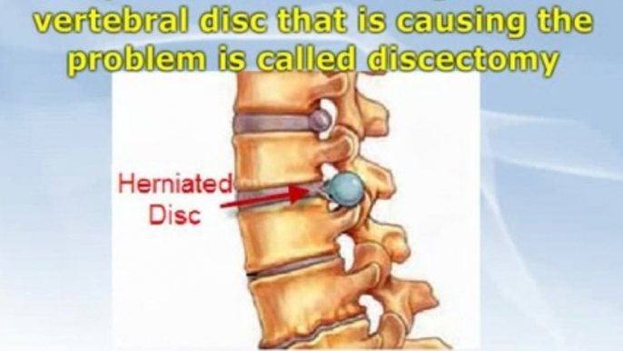 Disc herniation - causes and available treatments