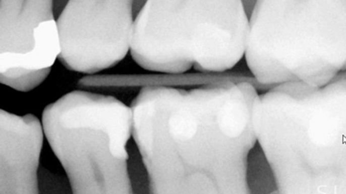 Intraoral Case Studies Imaged with Suni Sensors: Chapter 1