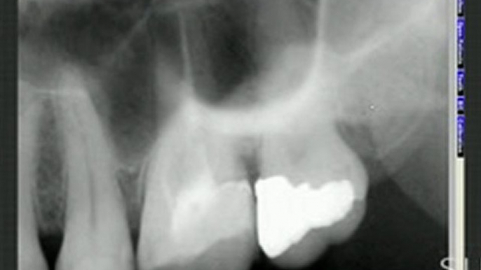 Intraoral Case Studies Imaged with Suni Sensors