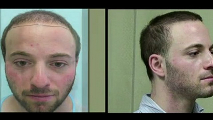 FUE Hair Transplants with Hybrid Body Hair Transplant