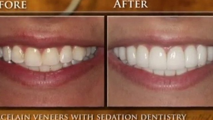 Porcelain Veneers Patient–Troy & Detroit Cosmetic Dentistry